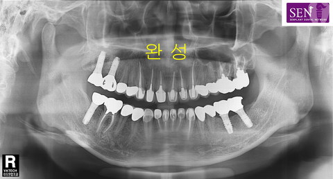 보철완성