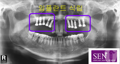 이차영-임플란트식립