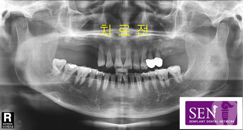 이차영-치료전