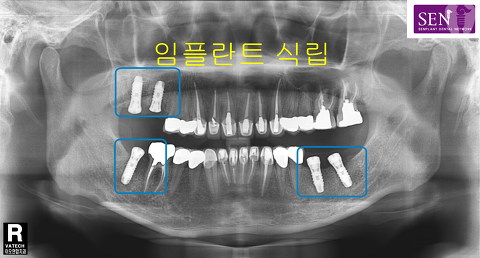 임플란트식립