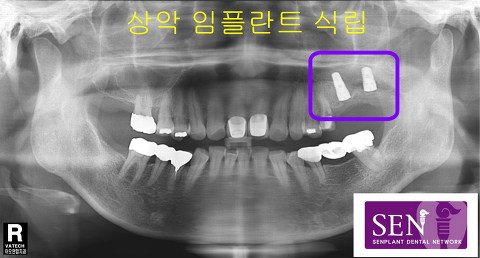 파노-상악_임플란트_1차식립