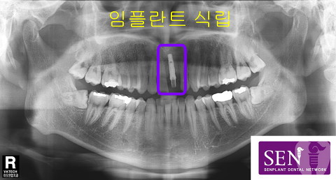 파노-임플란트_식립