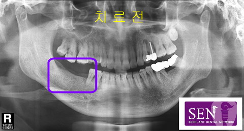 파노-치료전