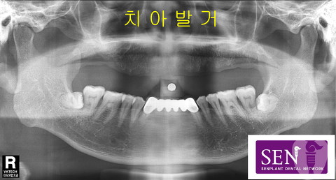 파노-치아발거